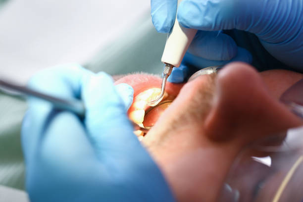 Best Chipped Tooth Repair Near Me  in Apalachicola, FL